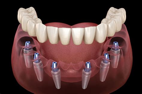 Full Mouth Dental Implants Near Me in Fort Washington,。